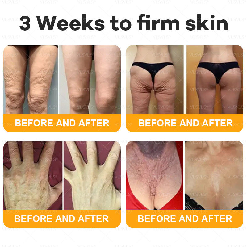 VLSVLS® Bee Venom Comprehensive Cream ✈️LAST DAY 80% OFF (Sagging Skin, Fine Lines, Loss of Firmness, Flat Bust, Drooping Hips, and More)